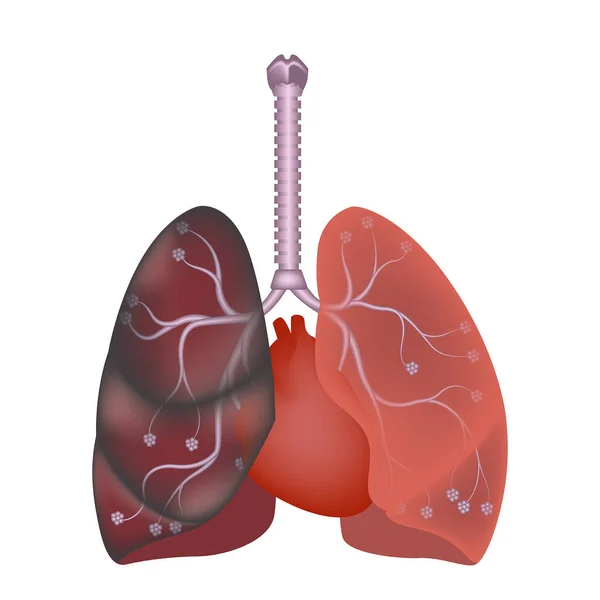 Smoker Lungs Defeat Nicotine Harm Tar Cigarette Pneumonia Covid Vector — Stock Vector