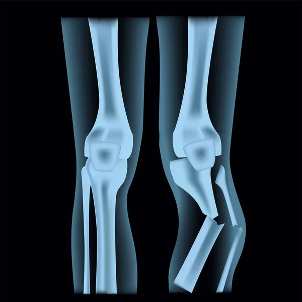 Ακτινογραφία Ανθρώπινων Ποδιών Γόνατο Άρθρωση Ανοιχτό Κάταγμα Μετατόπιση Εικονογράφηση Διανύσματος — Διανυσματικό Αρχείο