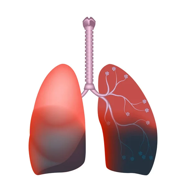 Polmonite Bilaterale Ascesso Polmonare Lesioni Infettive Illustrazione Vettoriale — Vettoriale Stock