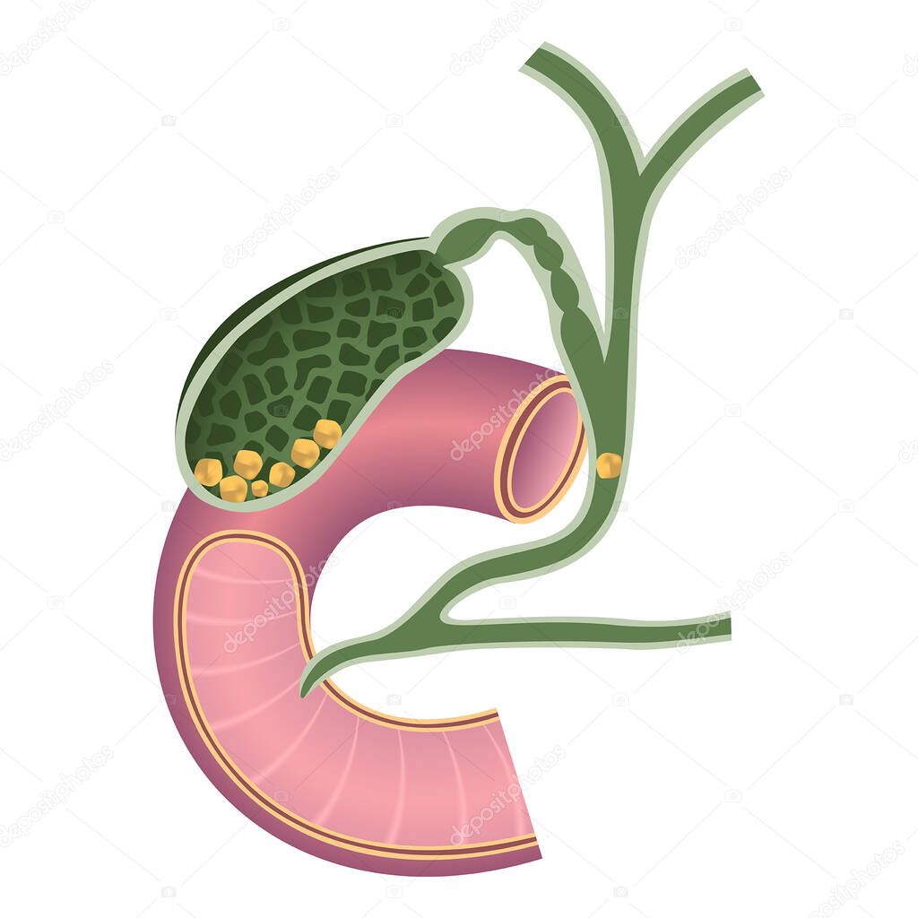 Gallstones. Chronic chrlecystitis. Digestive organs anatomy. Vector illustration.