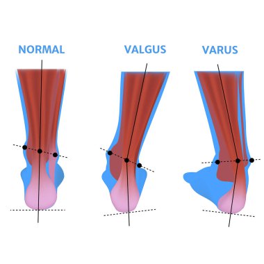 Ayağın Valgus deformasyonu. Ortopedik patoloji. Eklemlerde anormal deformasyon. Ayakların kıvrımı. Vektör illüstrasyonu.