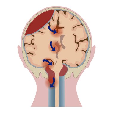 Doku bozulması olan beyin hematomu. Bölünmüş kafa. Tıbbi poster. Vektör illüstrasyonu