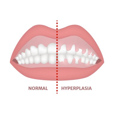 Gingival hiperplazi. Tıbbi poster. Vektör illüstrasyonu