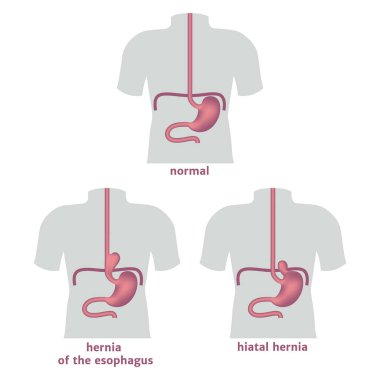 Torso with hernia of the stomach and esophagus. Medical poster. Vector illustration clipart