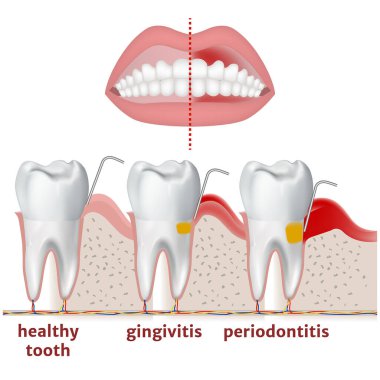 periodontitis and gingivitis. Diagram with disease of teeth and gums. Medical poster vector illustration clipart
