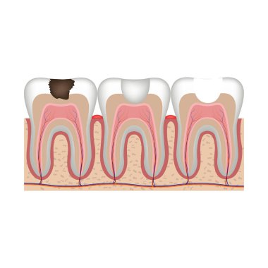 Caries. Diş dolgusu tedavisinin aşamaları. Vektör illüstrasyonu