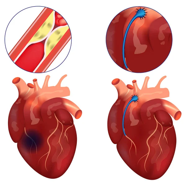 Contournement Coronarien Chirurgie Pour Rétablir Circulation Sanguine Dans Les Artères — Image vectorielle
