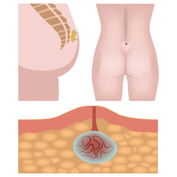 Une Maladie Pilonidale Fistule Dans Coccyx Dossier Médical Illustration Vectorielle — Image vectorielle