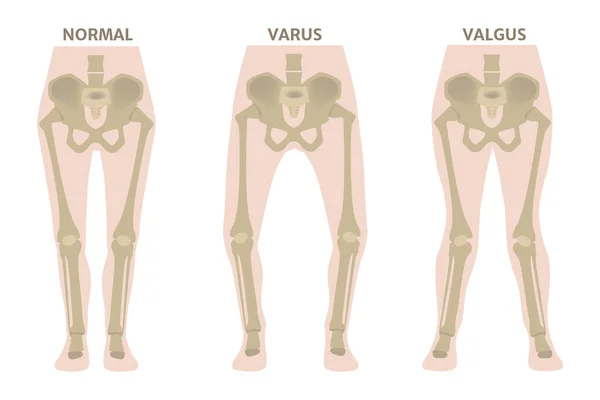 Деформації Ноги Вальгуса Варуса Діаграма Показує Деформовані Кістки Нижніх Кінцівок — стоковий вектор