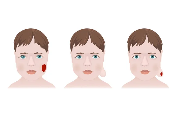 Arten Von Hämangiomen Gesicht Eines Kindes Medizinische Plakatvektorillustration — Stockvektor