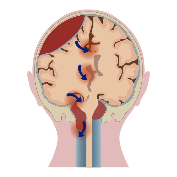 Hématome Cérébral Avec Distorsion Tissulaire Tête Sectionnée Affiche Médicale Illustration — Image vectorielle