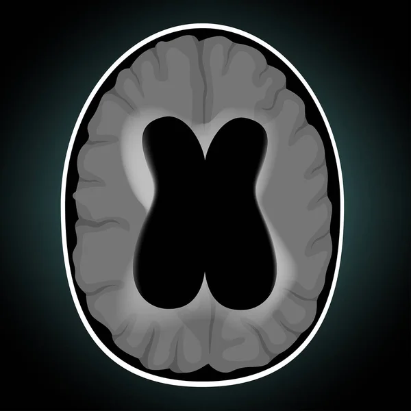 Idrocefalo Accumulo Liquido Cerebrospinale Eccesso Nei Ventricoli Del Cervello Illustrazione — Vettoriale Stock