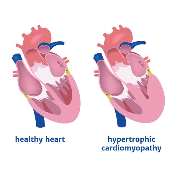 Гипертрофическая Кардиомиопатия Расширение Желудочка Сердца Векторная Иллюстрация — стоковый вектор