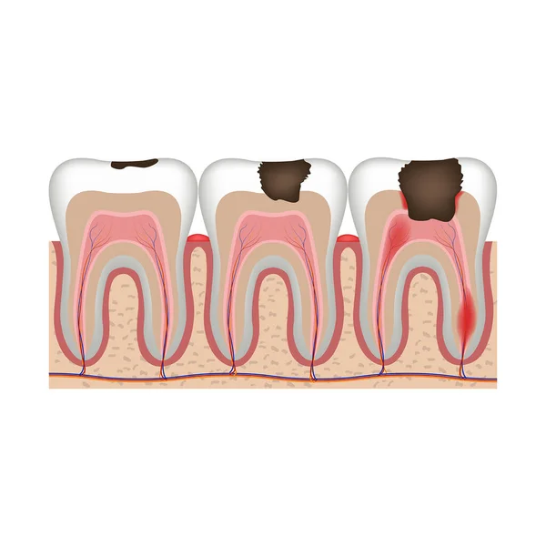 Etapas Caries Etapas Destrucción Dental Inflamación Pulpa Diagrama Vectorial Ilustrativo — Archivo Imágenes Vectoriales