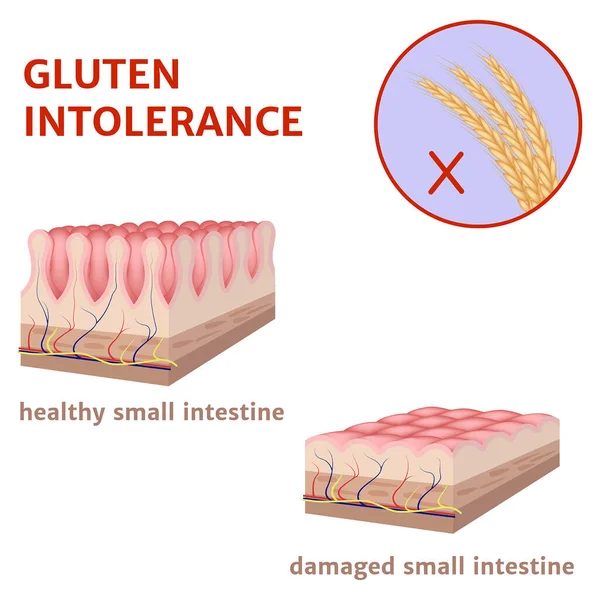 stock vector Gluten intolerance. Damaged surface of the small intestine. Medical poster. Vector illustration