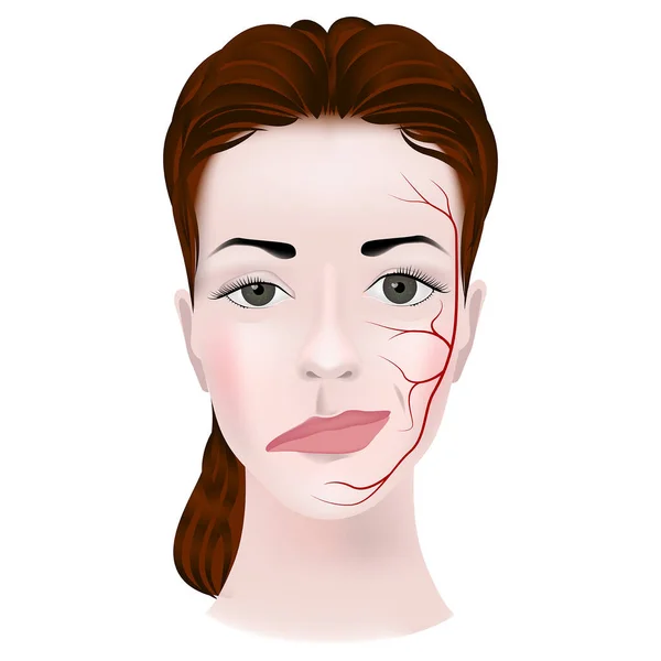 Myasthenie Das Verzerrte Gesicht Der Frau Schäden Triadischen Nerv Und — Stockvektor