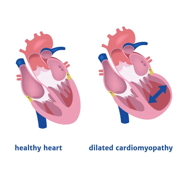 扩张型心肌病 心脏心室的扩张 医疗海报病媒说明 — 图库矢量图片