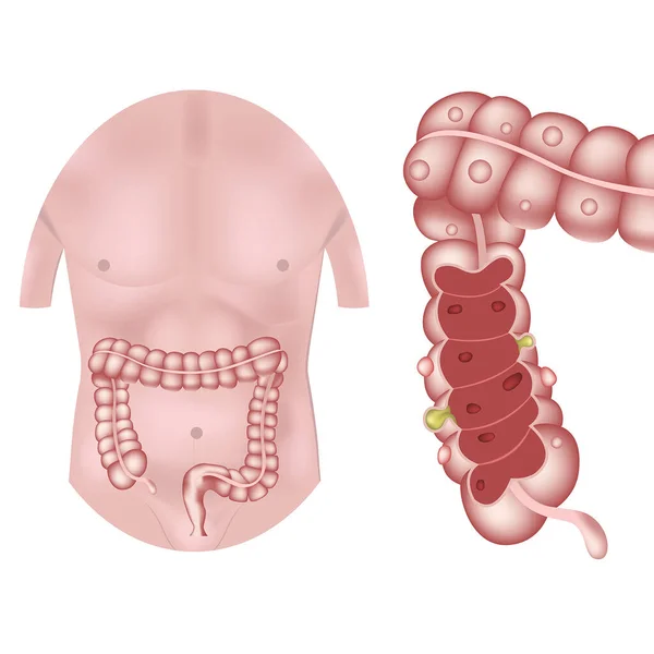 Verticale Ziekte Van Dikke Darm Infographic Met Romp Organen Vectorillustratie — Stockvector