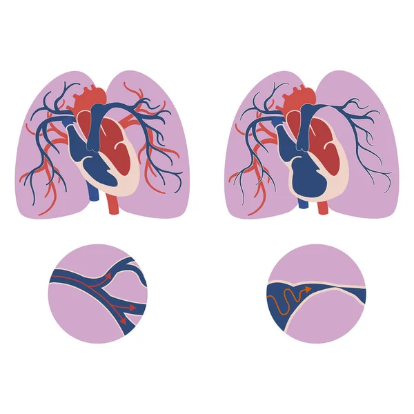 Pulmonary Hypertension Diagram Changes Heart Arteries Medical Poster Vector Illustration — Stock Vector