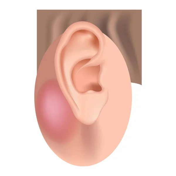 Mastoiditis Inflammatory Disease Ear Medical Poster Vector Illustration — Stock Vector