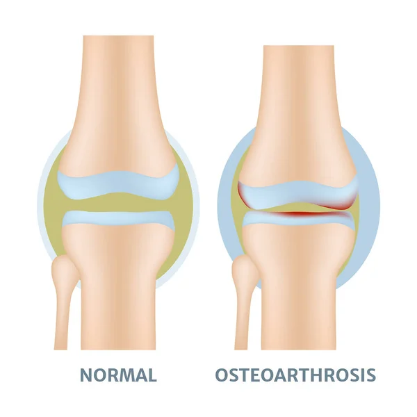 Osteopozlu Diz Eklemleri Vektör Düz Resimleme — Stok Vektör