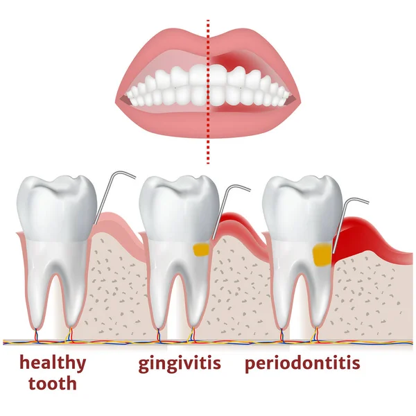 Parodontite Gengivite Schema Con Malattia Dei Denti Delle Gengive Illustrazione — Vettoriale Stock