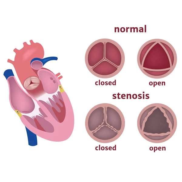 Estenosis Válvula Aórtica Del Corazón Infografía Enfermedades Ilustración Vectorial — Vector de stock