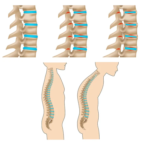 Spondylitis Inflammatory Disease Spine Destruction Vertebral Bodies Stages Spinal Deformity — Stock Vector