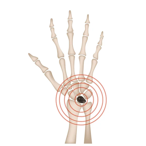 Kienbck Disease Anatomy Hand Aseptic Necrosis Semilunar Bone — Stock Vector