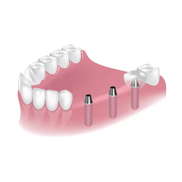Colocación Implantes Para Reconstrucción Los Dientes Mandíbula Inferior Cirugía Dental — Vector de stock