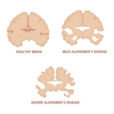 Alzheimer hastalığı. Patolojinin gelişim aşamaları ve etkilenmiş hipokampüs belirtileri. Tıbbi poster. Vektör illüstrasyonu