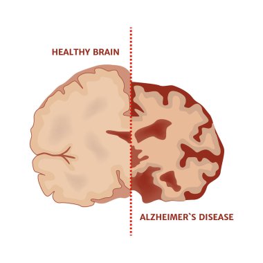 Beynin sağlıklı yarısı ve Alzheimer hastalığına sahip diyagram. Hastalıktan kaynaklanan yapısal hasar. Tıbbi poster. Vektör illüstrasyonu