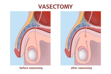 Vazektomi. İstenmeyen hamileliğin önlenmesi. Parçalanmış sperm kanalları. Erkek üreme sisteminin anatomisini gösteren diyagram. Tıbbi poster. Vektör illüstrasyonu