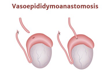 Vezin yeniden inşası erteleniyor. Vasovasoanastomoz. Erkek testislerinin anatomisi. Tıbbi poster. Vektör illüstrasyonu