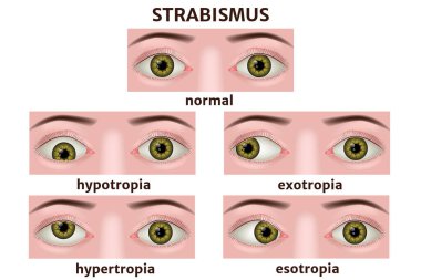 Strabismus çeşitleri. Göz hastalığı bilgileri. Tıbbi poster. Vektör illüstrasyonu