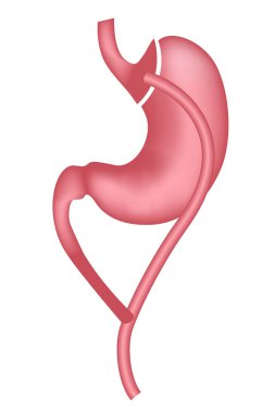 Gastrik baypas. Obezitenin ameliyatla tedavisi. Vektör illüstrasyonu