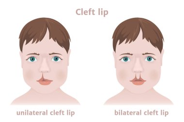 Doğuştan çocukluk patolojisi yarık dudak. Tek taraflı ve iki yüzlü. Gerçekçi bir yüz. Tıbbi poster. Vektör illüstrasyonu