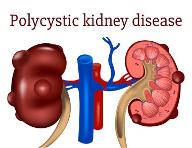 Polycystic kidney disease. genetic disease. Infographics of organs with cysts. Medical banner. Vector illustration clipart