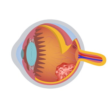 Göz kanseri, altta kötü huylu oluşum. Görüş organlarının yapısı ve anatomisi. Vektör illüstrasyonu