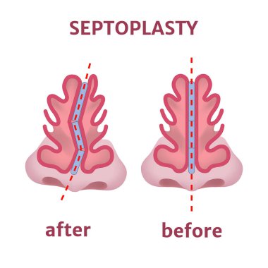 Septoplasti. Burun ameliyatı. Kıkırdak kıvrımlı. Tıbbi poster. Vektör illüstrasyonu