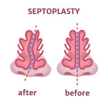 Septoplasty. Nose surgery. Curved cartilage. Medical poster. Vector illustration clipart