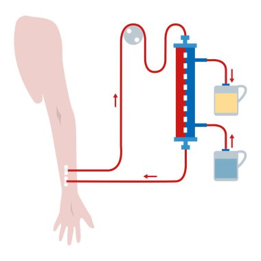 Renal hemodiyaliz şeması. Şartlı çizelge. tıbbi illüstrasyon