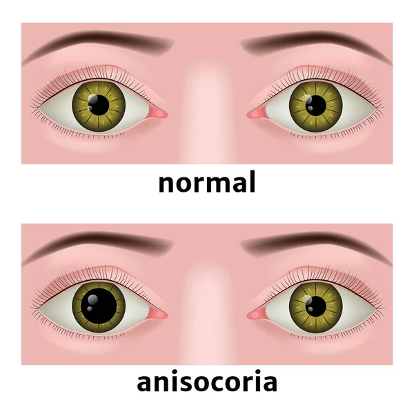 Anizokori. Gözbebeğinde anormal genişleme var. Ototistik hastalıklar. Tıbbi poster. İlk illüstrasyon