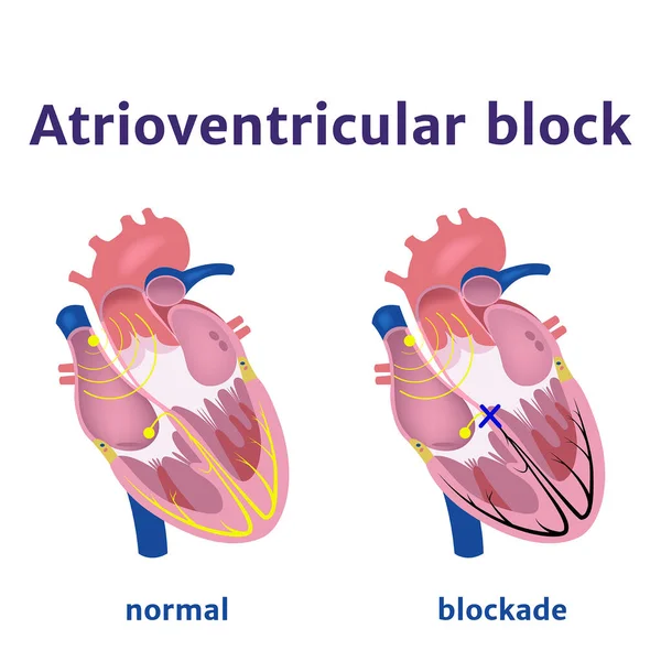 Bloqueo Auriculoventricular Violación Señal Eléctrica Corazón Ilustración Del Vector Médico — Vector de stock