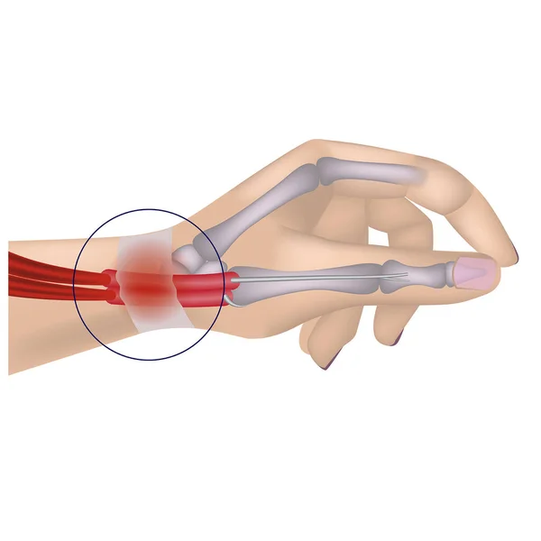 Quervains Sjukdom Yrkesmässig Sjukdom Handen Inflammation Senskiktet — Stock vektor