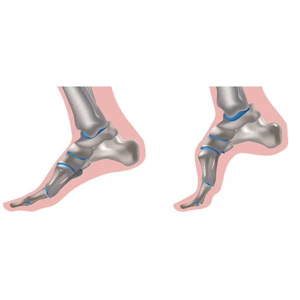 查科玛丽牙病 遗传病 有典型症状的病人的脚 遗传性运动神经病变 运动和感官周围神经纤维受损 — 图库矢量图片