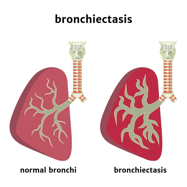 Bronchiectasie Elargissement Lumière Des Voies Respiratoires Inflammation Des Bronches Affiche — Image vectorielle