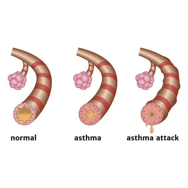 Keuhkoastma Alahengitysteiden Krooninen Tulehdus Tukehtumiskohtaukset Atooppinen Astma Lääketieteellinen Infografia Vektoriesimerkki — vektorikuva