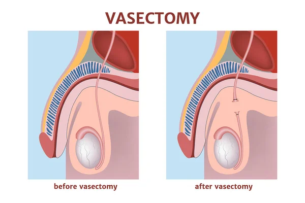Vasectomia Prevenção Gravidez Indesejada Dutos Seminais Cortados Figura Com Anatomia —  Vetores de Stock