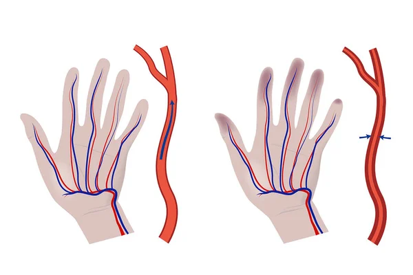 Vibrationssyndrom Hand Mit Einem Diagramm Verengter Blutgefäße Medizinisches Plakat Vektorillustration — Stockvektor